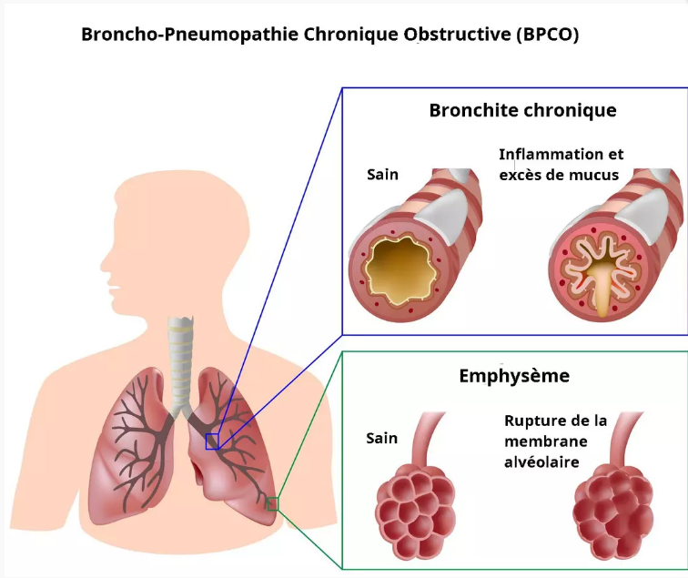 Qu Est Ce Que La MPOC Association Pulmonaire Du Canada